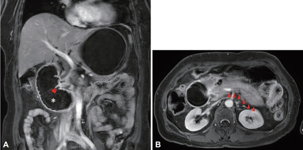 Duodenal Bezoar: A Rare Cause of Acute Pancreatitis.