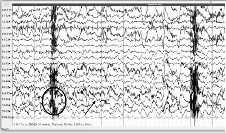 Mesial temporal sclerosis and epilepsy: a narrative review.
