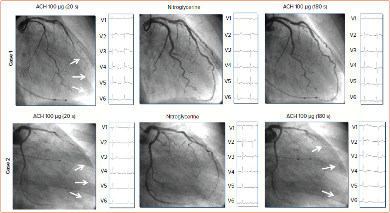The Need for Separate Testing with Acetylcholine for the Assessment of Endothelial Dysfunction and Coronary Artery Spasm.
