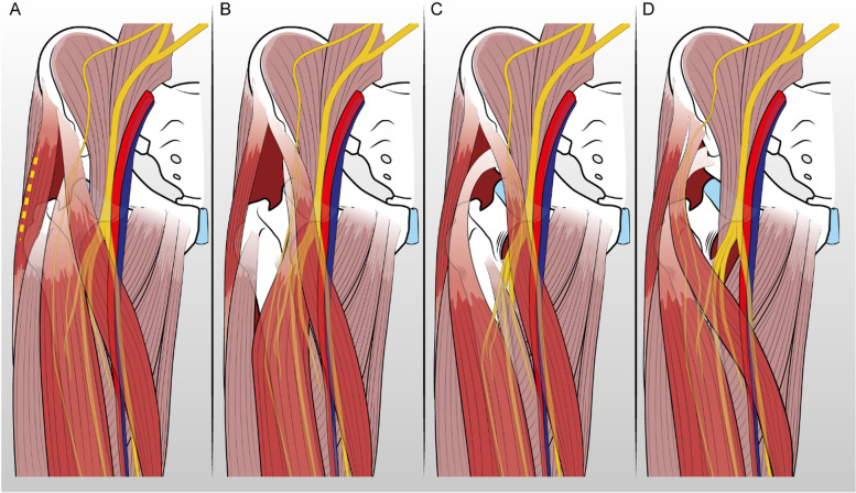 Should we be concerned when the anterior approach to the hip goes accidentally medial? A retrospective study.