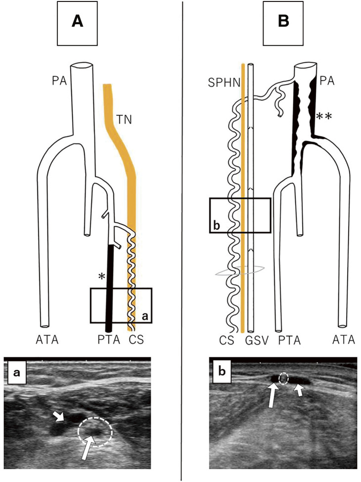 Ultrasonographic Study of the Corkscrew Arterial Image in Buerger Disease Patients.