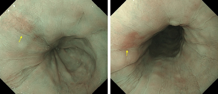 Surveillance for metachronous cancers after endoscopic resection of esophageal squamous cell carcinoma.