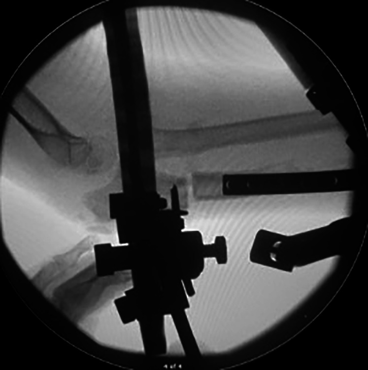 Indirect Hexapod Frame-assisted Reduction of Chronic Radial Head Dislocations in Children: 20-year Experience and Technical Tips.