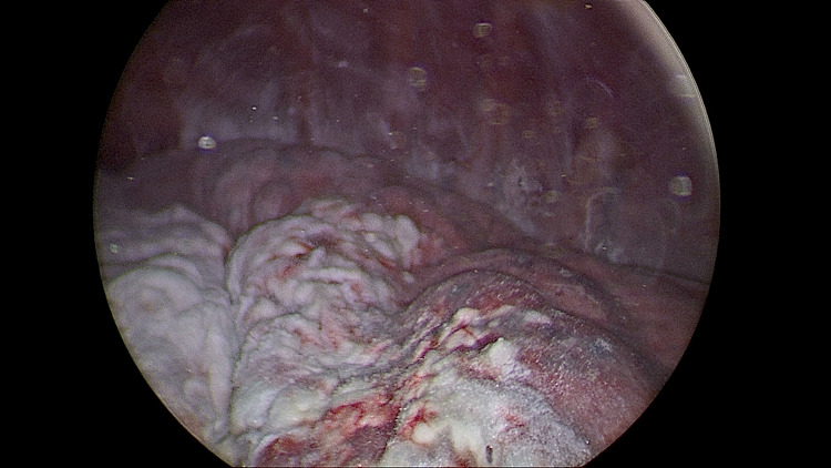 The Role of Medical Thoracoscopy with Talc Poudrage in Spontaneous, Iatrogenic, and Traumatic Pneumothorax: A Prolonged Experience of a Tertiary Care Center.