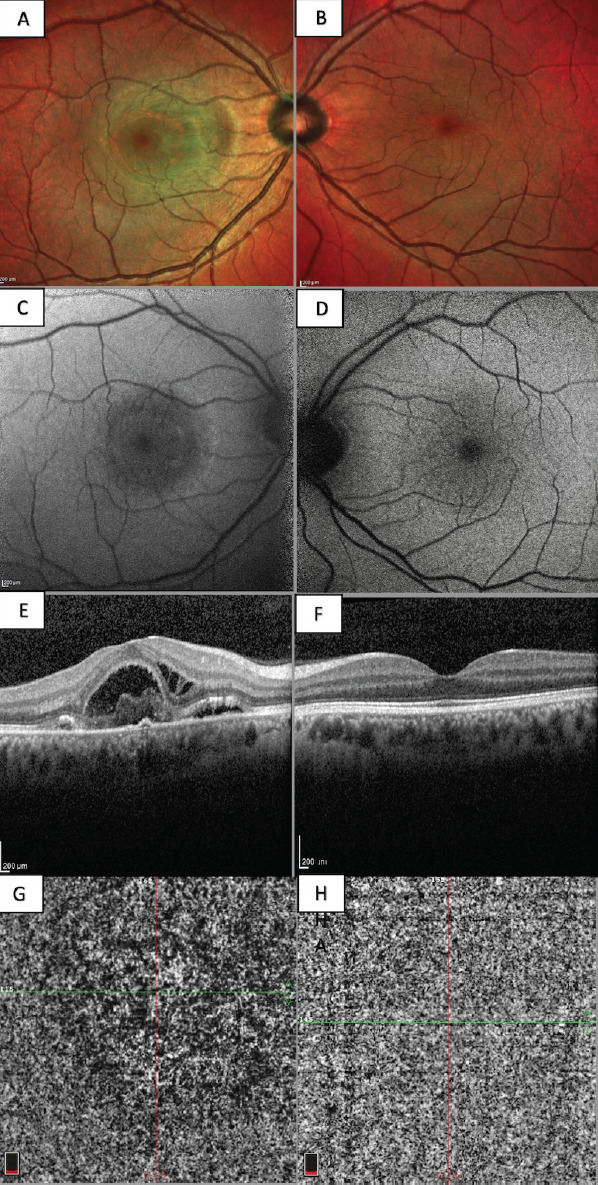 The Relevance of Bacillary Layer Detachment and Choroidal flow Insufficiency in Unilateral Acute Idiopathic Maculopathy Associated with Hand, Foot, and Mouth Disease: A Case Report.