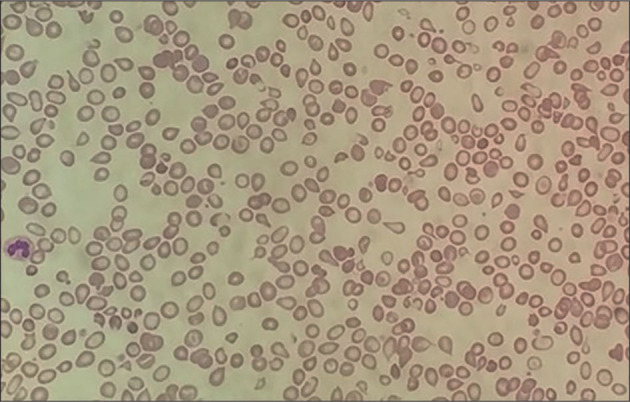 The Importance of Molecular Biological Analysis for the Laboratory Diagnostic of Homozygous Haemoglobin Malay.