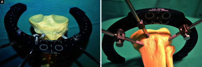 Technical Article: Short-segment Placement of Proximal Tibial Half-pins.