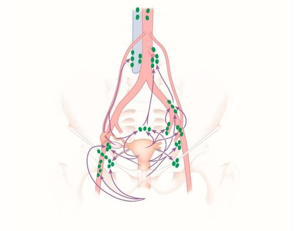 ICG mapping of postoperative lymphatic leakage in the groin: a video article and literature review.