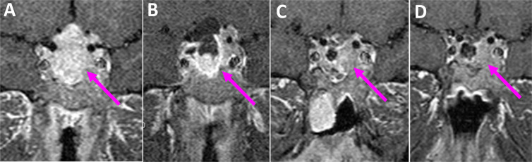 The Optimal Time for Postoperative Magnetic Resonance Imaging of the Sella in Patients With Pituitary Adenoma.
