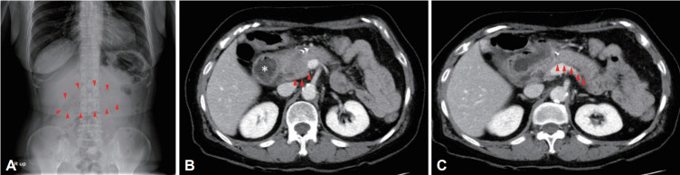 Duodenal Bezoar: A Rare Cause of Acute Pancreatitis.