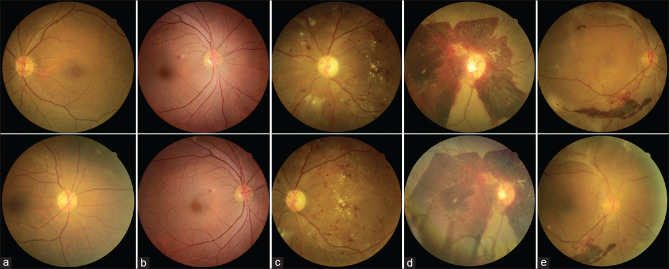 Effectiveness of artificial intelligence for diabetic retinopathy screening in community in Binh Dinh Province, Vietnam.