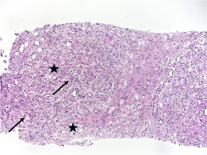 Methotrexate induced hepatotoxicity in metabolic dysfunction-associated steatotic liver disease.