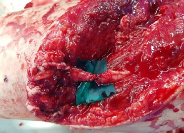 Experience of vascular injuries at a military hospital in Korea.