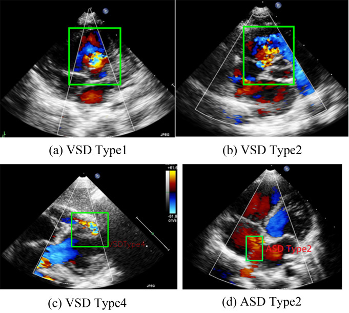 Optimizing Object Detection Algorithms for Congenital Heart Diseases in Echocardiography: Exploring Bounding Box Sizes and Data Augmentation Techniques.