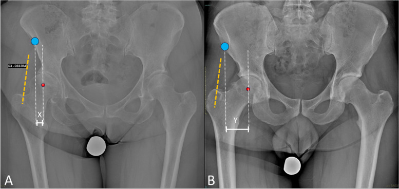 Should we be concerned when the anterior approach to the hip goes accidentally medial? A retrospective study.