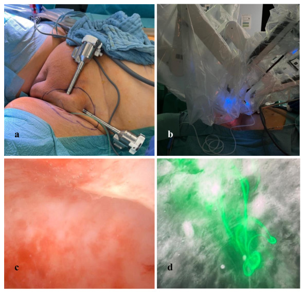 ICG mapping of postoperative lymphatic leakage in the groin: a video article and literature review.
