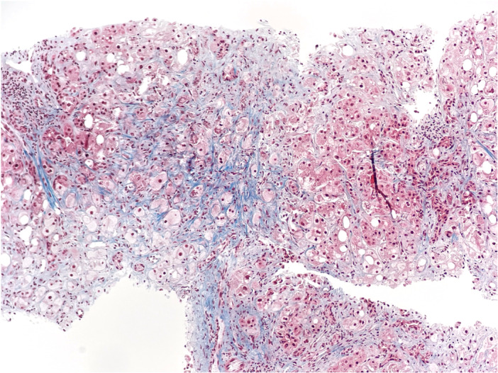 Methotrexate induced hepatotoxicity in metabolic dysfunction-associated steatotic liver disease.