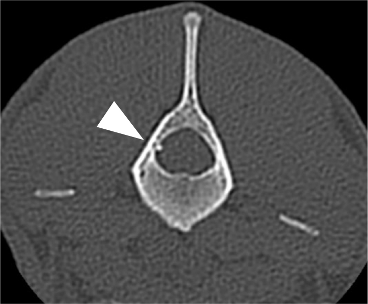 The perfusion index as a method of assessing epidural anaesthesia efficacy in healthy dogs.