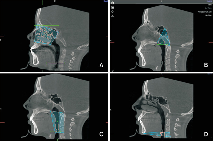 Upper airway dimensions and craniofacial morphology: A correlation study using cone beam computed tomography.