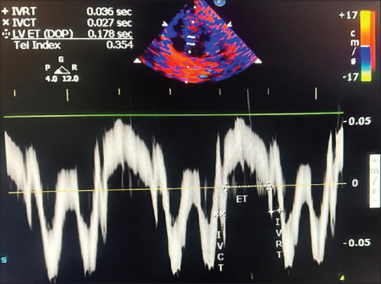 Comparing the tissue Doppler-derived left ventricular myocardial performance index before and after recovery from respiratory distress in neonates: A prospective observational study.