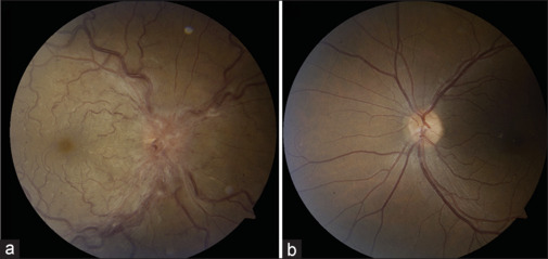 Optic Neuritis - The Evolving Spectrum.