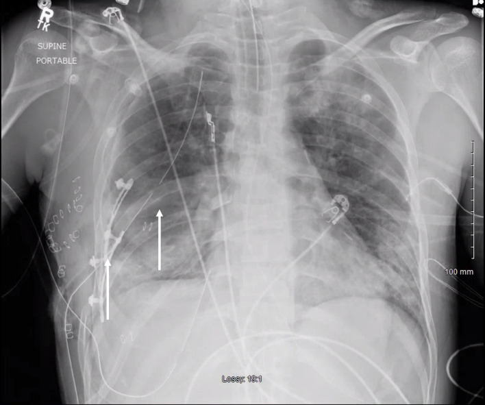 Conservative Treatment of Empyema Formation Following Intrathoracic Rib Fixation With Antibiotics and Tissue Plasminogen Activator/Dornase.