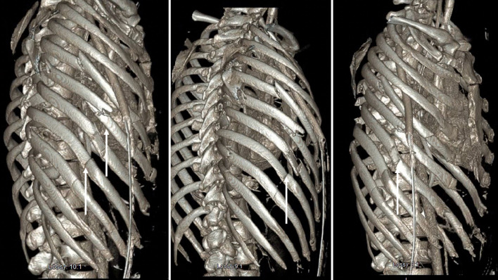 Conservative Treatment of Empyema Formation Following Intrathoracic Rib Fixation With Antibiotics and Tissue Plasminogen Activator/Dornase.