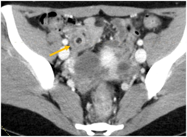 Appendiceal intussusception due to endometriosis presenting as acute right lower quadrant pain.