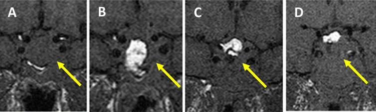 The Optimal Time for Postoperative Magnetic Resonance Imaging of the Sella in Patients With Pituitary Adenoma.