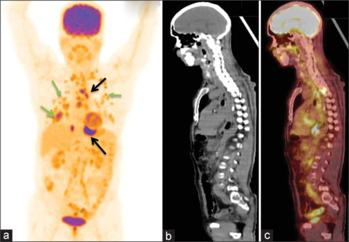 Utility of [18F]FDG- PET/CT in Initial Staging and Management of Patients with Esophageal Carcinoma: A Tertiary Care Center Experience.