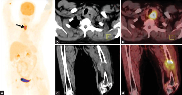 Utility of [18F]FDG- PET/CT in Initial Staging and Management of Patients with Esophageal Carcinoma: A Tertiary Care Center Experience.