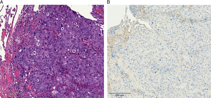 Nivolumab as a Promising Treatment Option for Metastatic Salivary Duct Carcinoma.