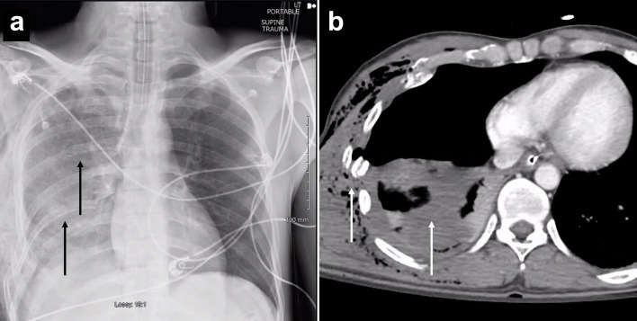Conservative Treatment of Empyema Formation Following Intrathoracic Rib Fixation With Antibiotics and Tissue Plasminogen Activator/Dornase.