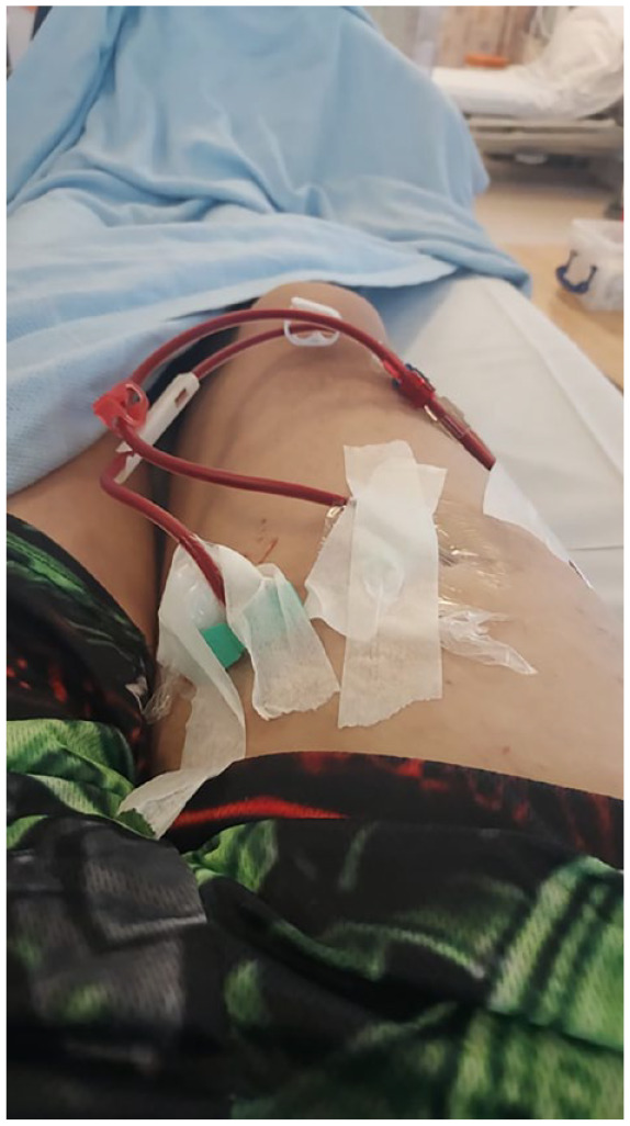 Progressing the understanding of chronic illness and its treatment: A post-human, ethological understanding of haemodialysis.
