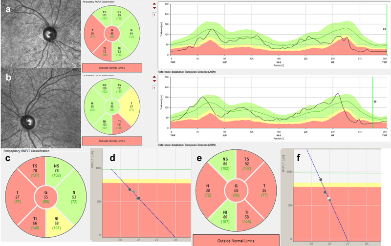 Adult-Onset Bilateral Optic Neuropathy in a Patient with Non-Familial Childhood-Onset Generalized Dystonia Associated with Mitochondrial DNA 14459G>A Mutation: A Case Report and Review of Literature.