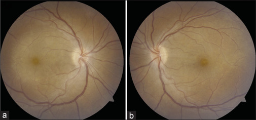 Optic Neuritis - The Evolving Spectrum.