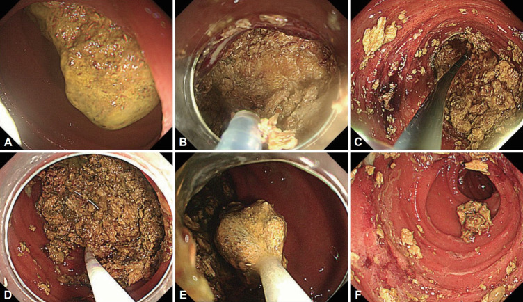 Duodenal Bezoar: A Rare Cause of Acute Pancreatitis.