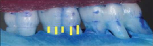 Effect of exposure to the carcinogen 50 ppm 4-nitroquinoline 1-oxide on alveolar bone loss.