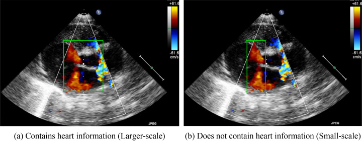 Optimizing Object Detection Algorithms for Congenital Heart Diseases in Echocardiography: Exploring Bounding Box Sizes and Data Augmentation Techniques.