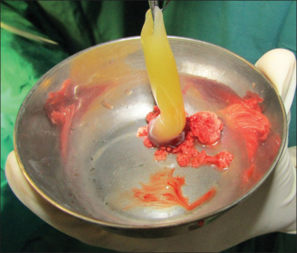 Effect of "platelet rich" fibrin with bone marrow aspirate on the regenerative capacity of alveolar bone grafting with iliac bone graft: A randomized controlled trial.