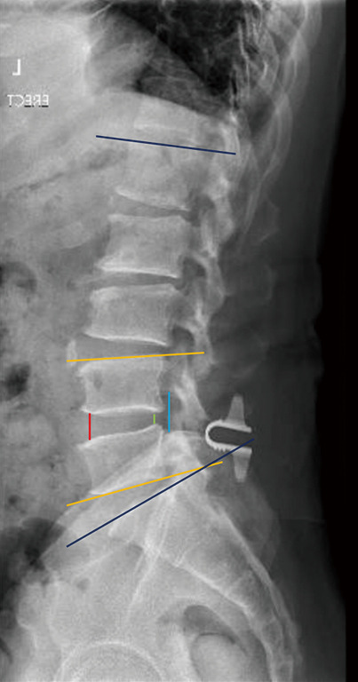 Five-year radiological outcomes between decompression alone and decompression with an interlaminar device for lumbar spinal stenosis.