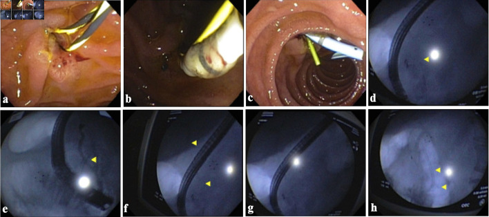 Bilio-Cecal Stent Migration Presenting as Massive Rectal Bleeding.