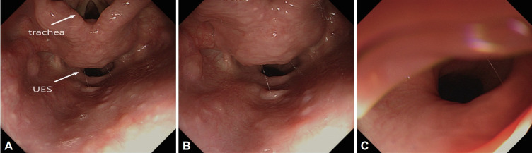Abnormal Opening in Hypopharynx by Screening Upper Endoscopy.