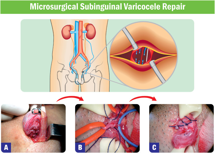 From pathophysiology to practice: addressing oxidative stress and sperm DNA fragmentation in Varicocele-affected subfertile men.