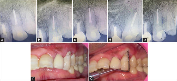 Surgical reconstruction of invasive external cervical root resorption with perforation and associated periodontal defect using novel bioceramic materials and cone beam computed tomography as a diagnostic adjunct- A case report.