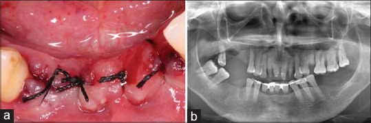 Stage IV, grade B periodontitis in a patient with coinfection with the human immunodeficiency virus, hepatitis C, and oral candidiasis.