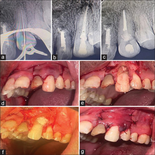 Surgical reconstruction of invasive external cervical root resorption with perforation and associated periodontal defect using novel bioceramic materials and cone beam computed tomography as a diagnostic adjunct- A case report.