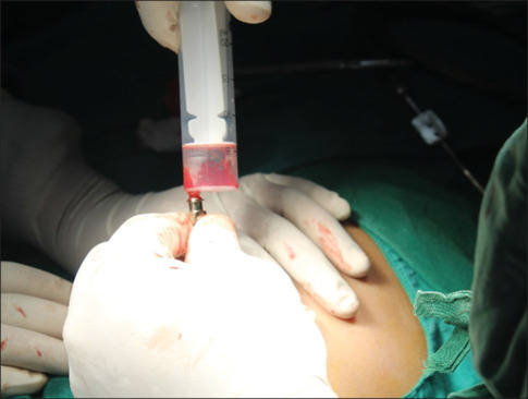 Effect of "platelet rich" fibrin with bone marrow aspirate on the regenerative capacity of alveolar bone grafting with iliac bone graft: A randomized controlled trial.