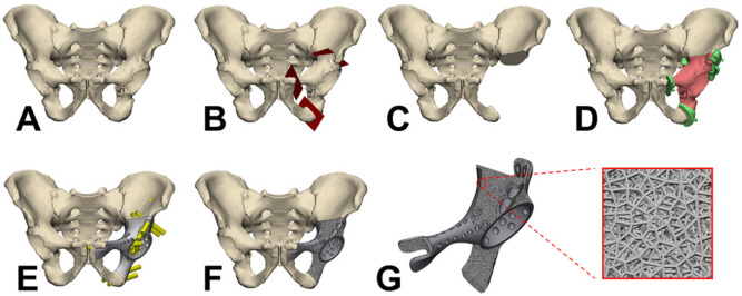 Design, characterisation, and clinical evaluation of a novel porous Ti-6Al-4V hemipelvic prosthesis based on Voronoi diagram.