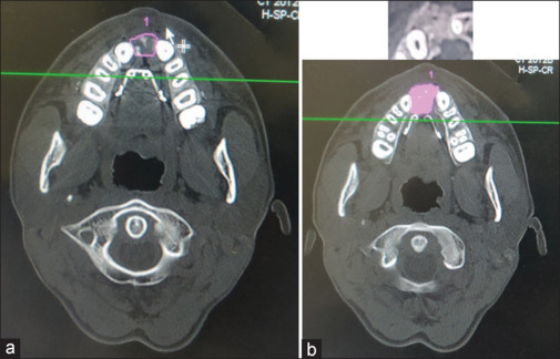 Effect of "platelet rich" fibrin with bone marrow aspirate on the regenerative capacity of alveolar bone grafting with iliac bone graft: A randomized controlled trial.